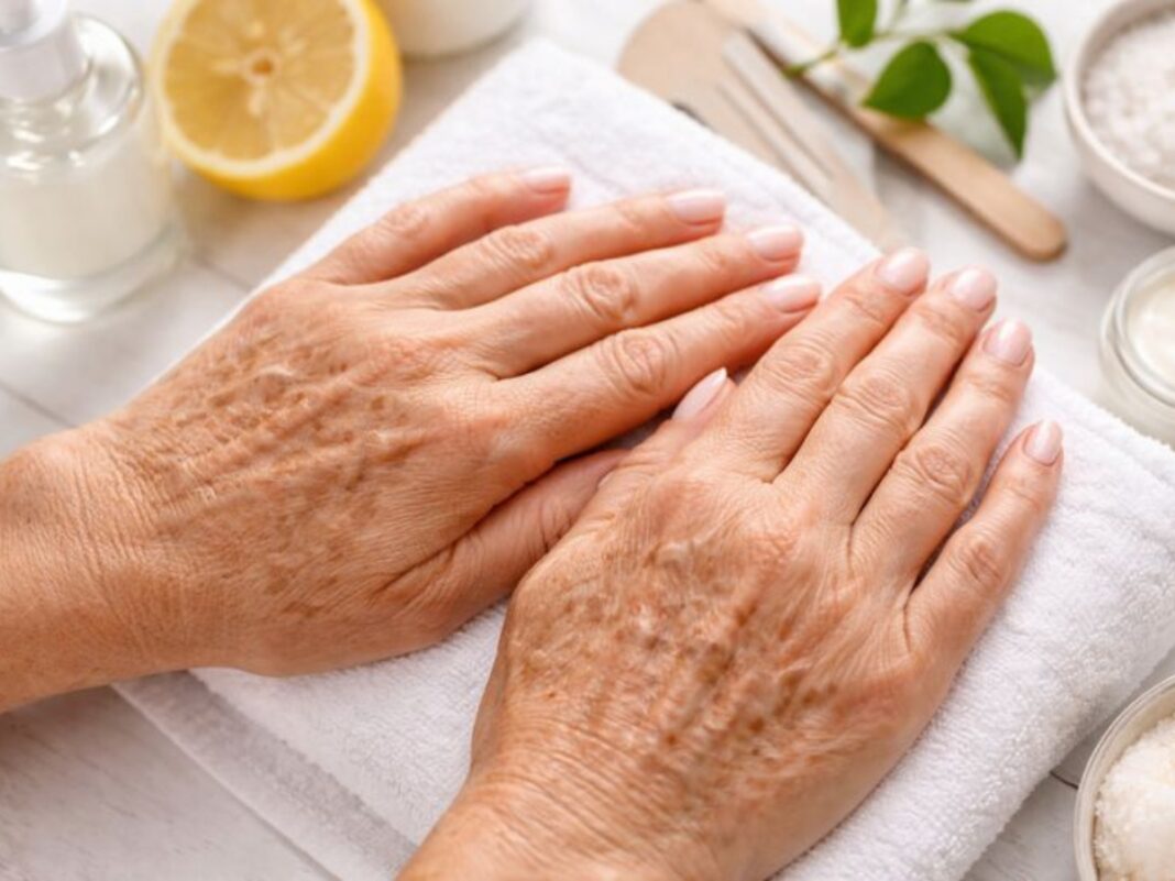 Πανάδες στα χέρια: Πώς μπορείτε να απαλλαγείτε από το πρόβλημα