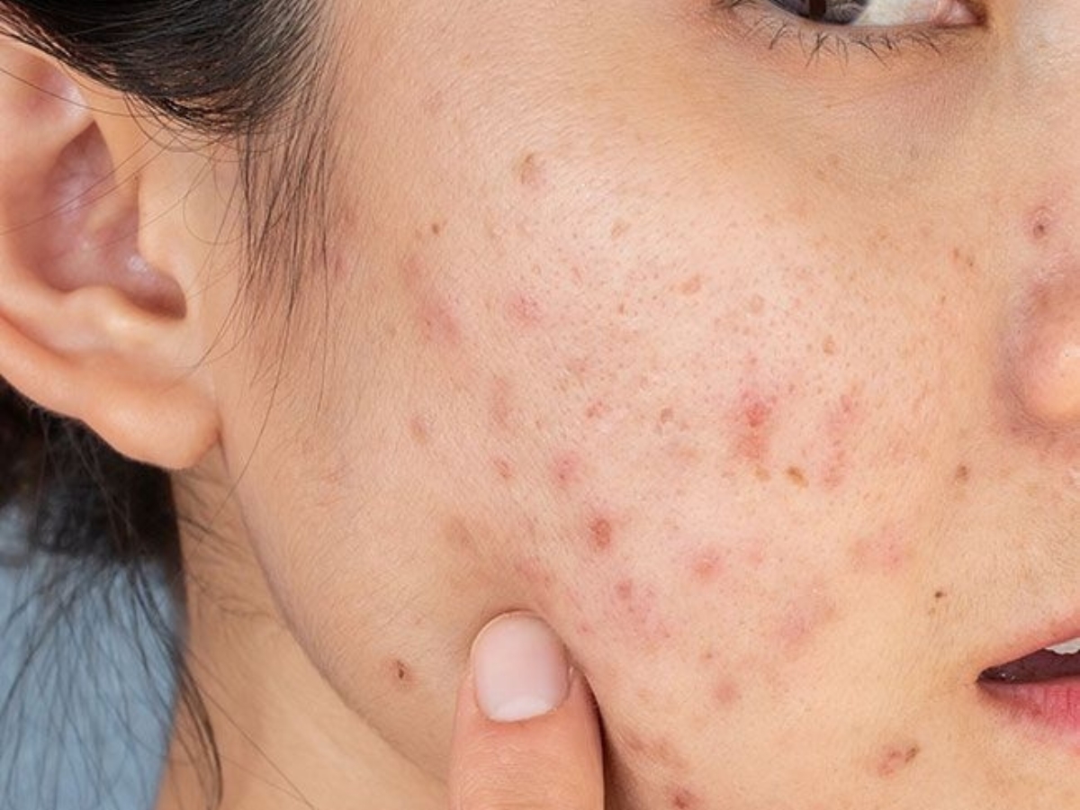 Ακμή: Πώς την αντιμετώπισα φυσικά σε 6 εβδομάδες χωρίς δερματολόγο