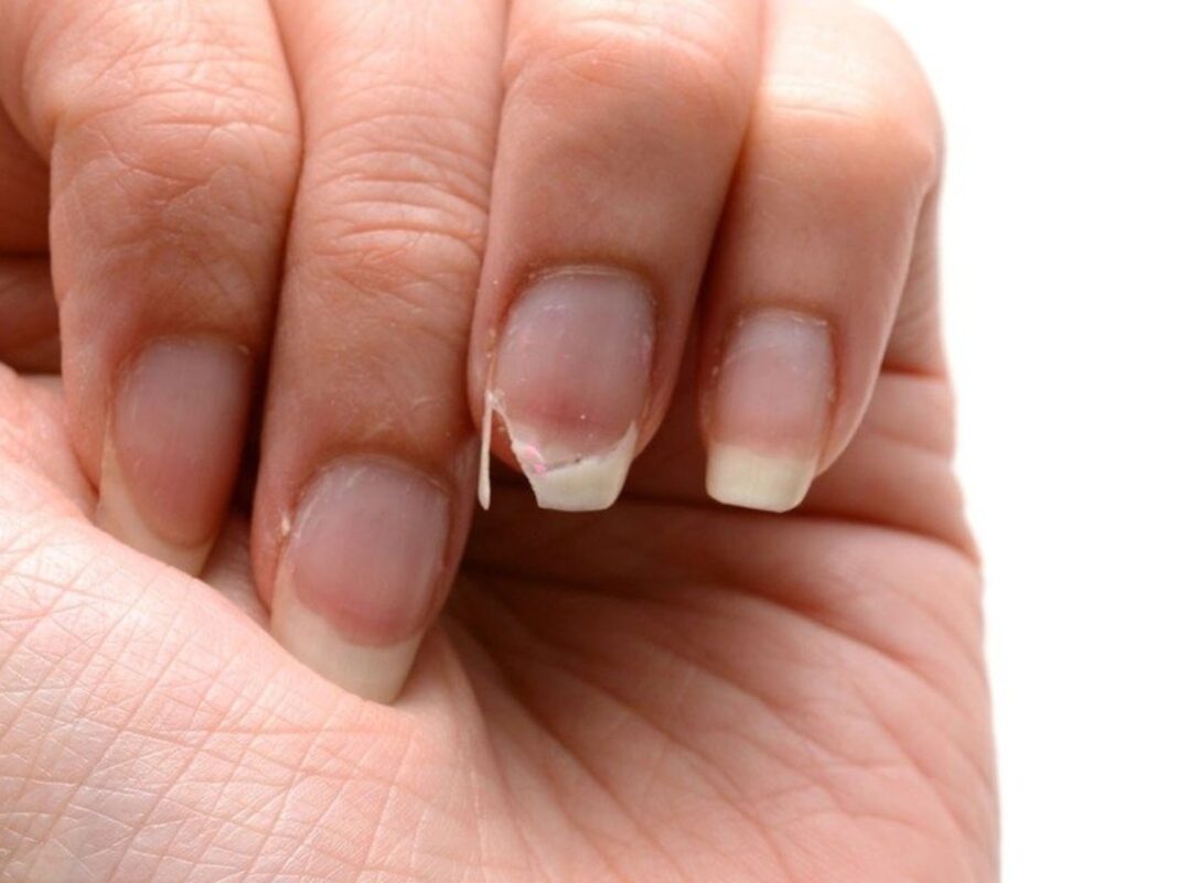 Σπάνε τα νύχια σου στην άκρη; Τα 5 λάθη που τα αποδυναμώνουν χωρίς να το ξέρεις Σπάνε τα νύχια σου στην άκρη; Τα 5 λάθη που τα αποδυναμώνουν χωρίς να το ξέρεις